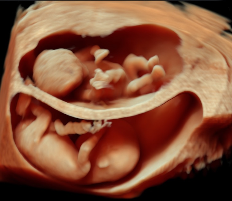 SYN DYAG: Development of a system for 3D face comparison aimed at medically diagnosing rare diseases and syndromes involving face dysmorphisms